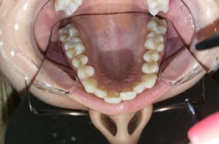 Láthatatlan fogszabályozó kezelés 4,5 hónap