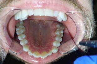 Láthatatlan fogszabályozó kezelés 8 hónap
