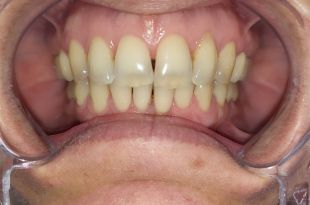 Láthatatlan fogszabályozó kezelés 3,5 hónap